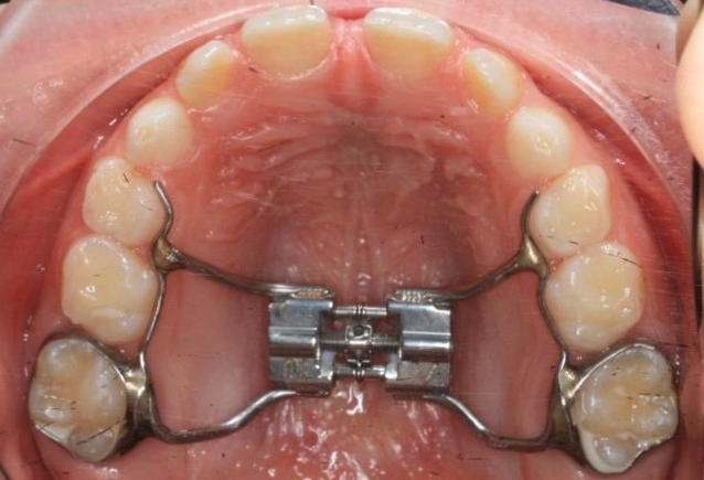 Nouvel appareil orthodontique dentaire Alignement Er pour adulte